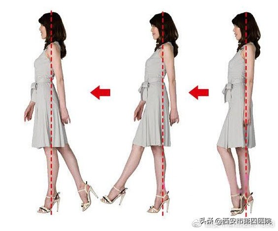 椎间盘突出压迫神经怎么治,为什么会有椎间盘突出