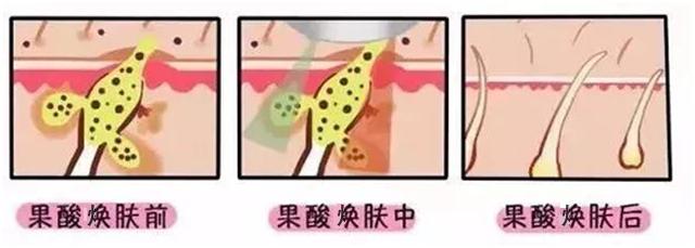 改善鸡皮肤身体乳果酸,果酸换肤改善鸡皮肤