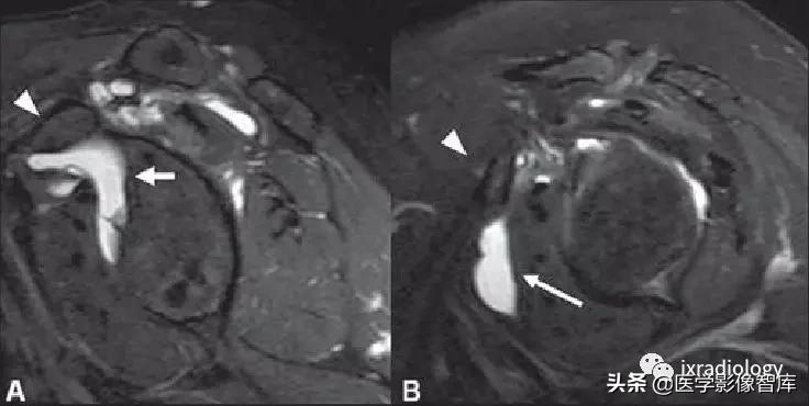 肩关节滑膜解剖,肩关节周围肌肉解剖