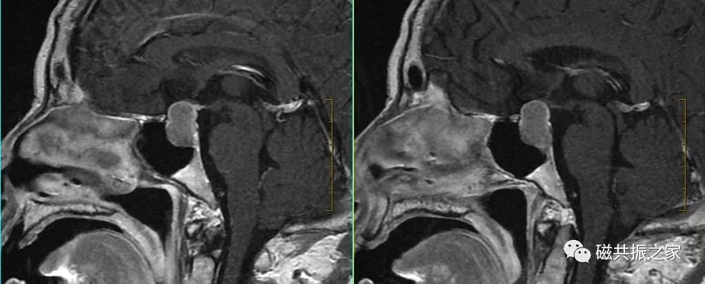垂体mri扫描,垂体微腺瘤mri扫描