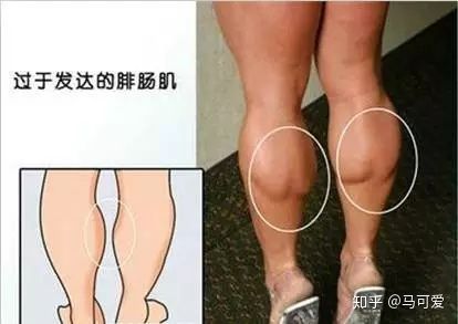 小腿粗可以通过运动改善吗,小腿能粗到什么地步