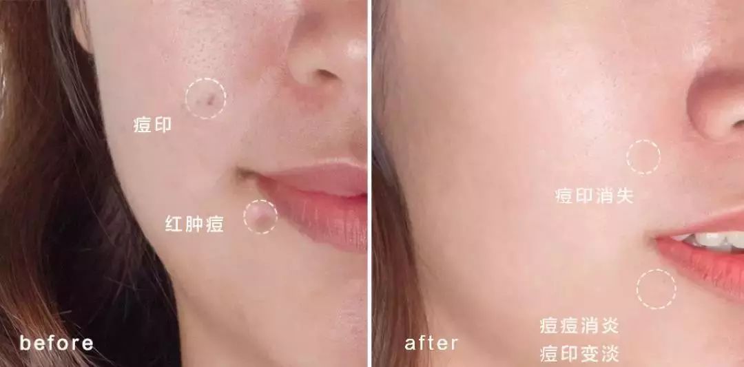 长痘后脸上坑坑洼洼？怎样才能去除痘坑？