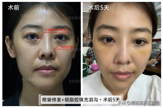 外切眼袋手术后凹陷图片,外切眼袋后怎么感觉特别有整容感