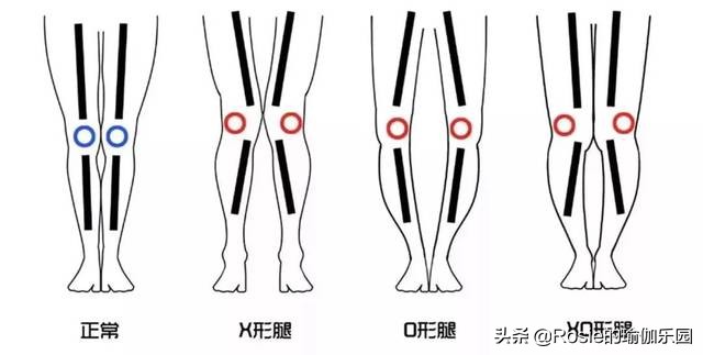 锻炼小腿内侧肌肉改善O型腿,小腿粗大腿壮如何变细腿