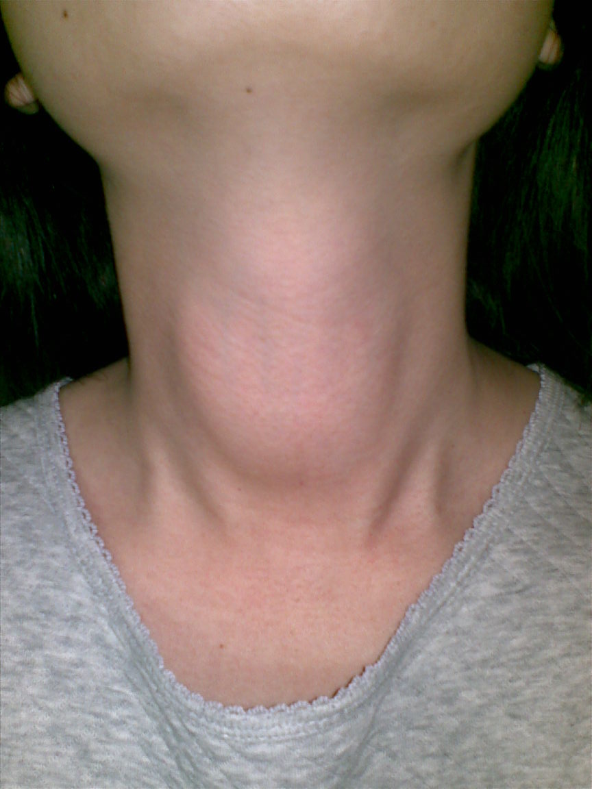 板层状鱼鳞病怎么引起,板层状鱼鳞病是单基因吗