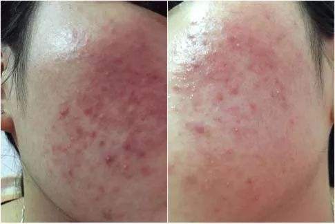 老中医化妆品能修复激素脸吗,老中医治疗激素脸