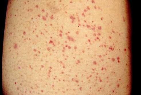 家长疑虑:什么是小儿过敏性紫癜?我们都没有听说过这种疾病