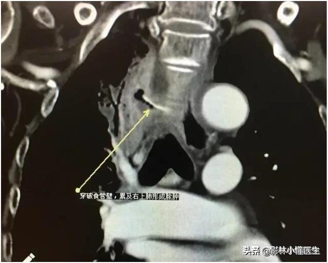 误吞假牙吃什么有助于排出,误吞假牙怎么处理