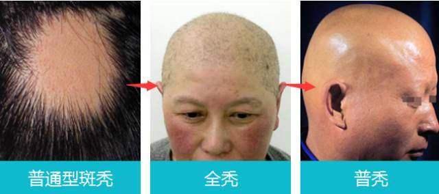 脱发严重是身体哪出问题了,脱发了好可怕