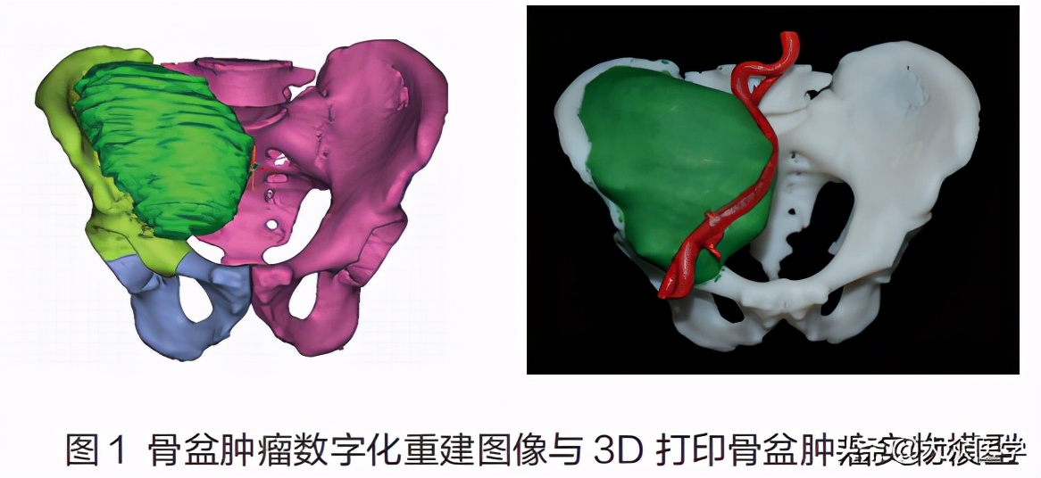 3d打印骨盆成功案例,3d打印肿瘤技术视频