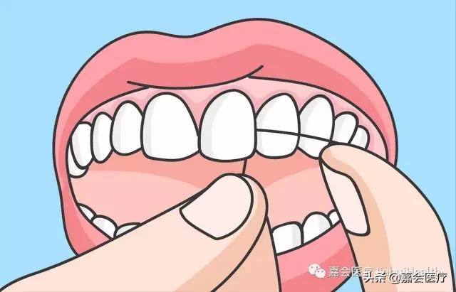 刷完牙用牙线清理牙垢多余吗,刷牙只能清洁70%的牙齿