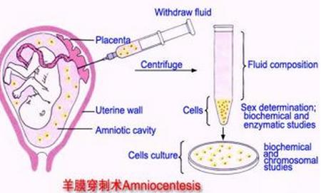 妇产科医生：什么是羊水穿刺？哪些孕妈妈需要做这个检查？