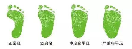 有效预防拇指外翻和扁平足,为了预防扁平足我们要穿什么鞋