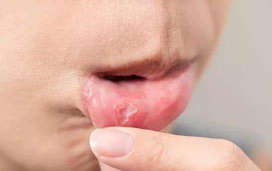 槟榔吃多了怎么治愈,槟榔吃多了还能治好吗