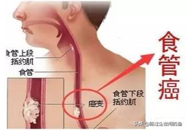 消化系统癌症都有哪些？你知道怎样预防吗？