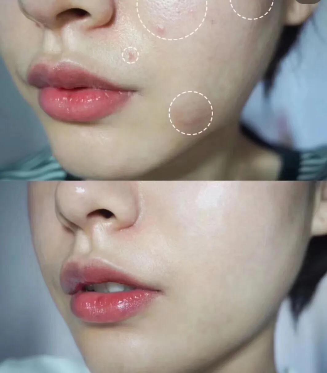 毛孔黑头堵塞严重变成一片疙瘩,敏感肌毛孔堵塞黑头怎么改善