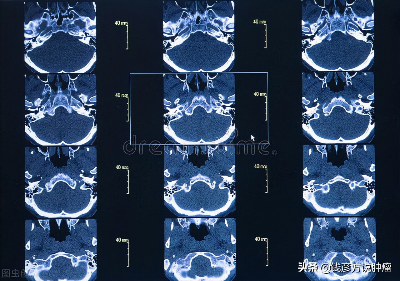 结节较前不明显是什么意思,结节为什么有时检查不出来