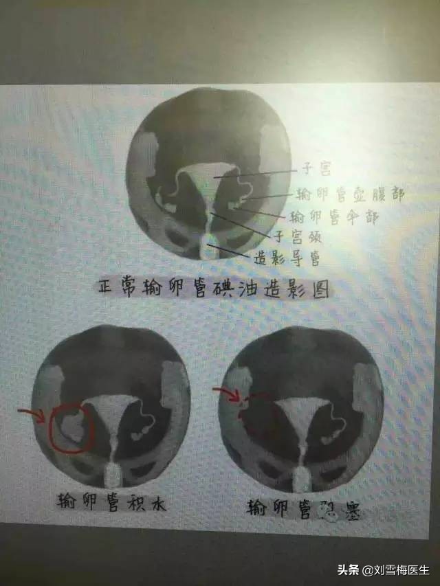 阴超可以检查输卵管堵塞吗,阴超可以检查出输卵管炎症吗