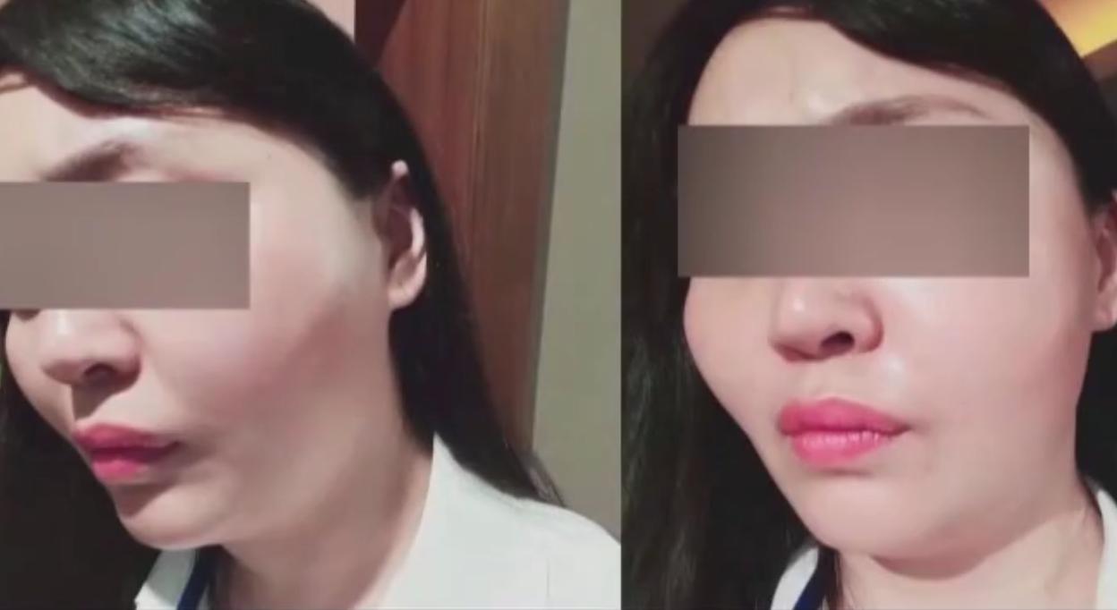 注射美容针后果,女子花一万元注射整形