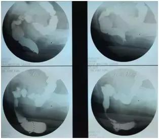 肛肠科：直肠前突是造成便秘的主要因素之一！