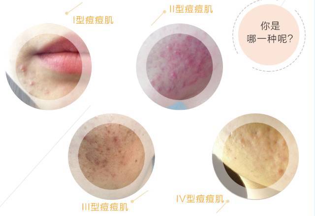 战痘小绝招科学祛痘让你少走弯路,两三年的痘印怎么祛痘好
