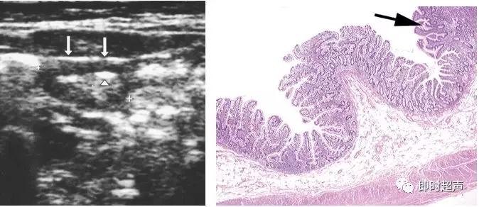 小儿消化道急症超声
