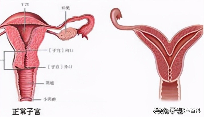 子宫发育正常是否会子宫幼稚,幼稚子宫和子宫发育不良的区别