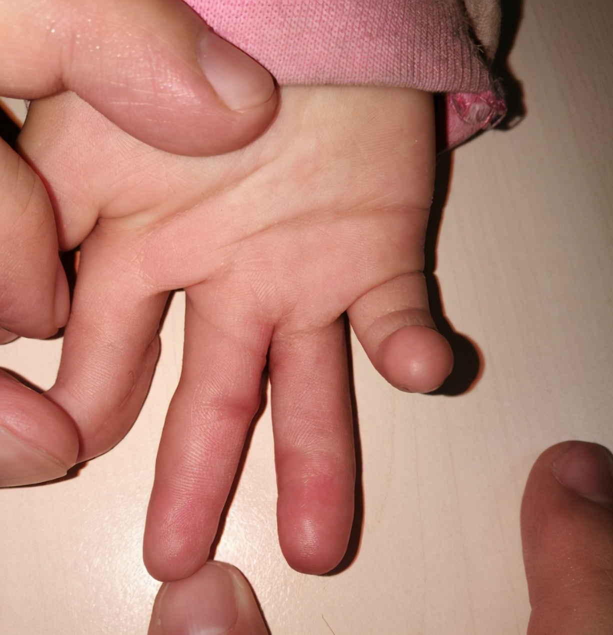 并指畸形免植皮案例,并指畸形