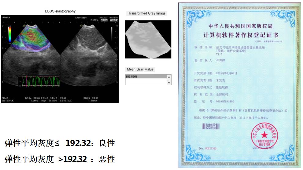 小细胞肺癌的气管镜介入治疗,导航支气管镜在肺癌诊断中的应用