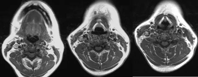 喉部病变做核磁还是ct,耳鼻喉科常见病影像诊断