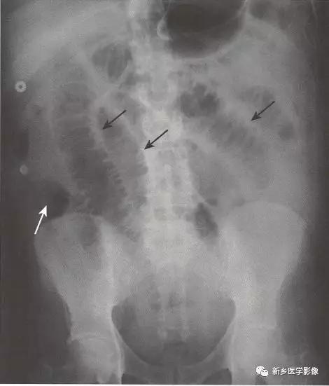 辨识肠梗阻,肠梗阻死亡前兆