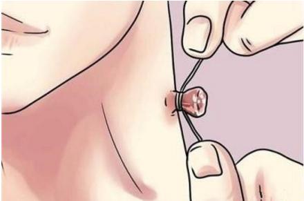 脖子出现小肉刺是怎么回事,脖子出现的小肉疙瘩是怎么引起的