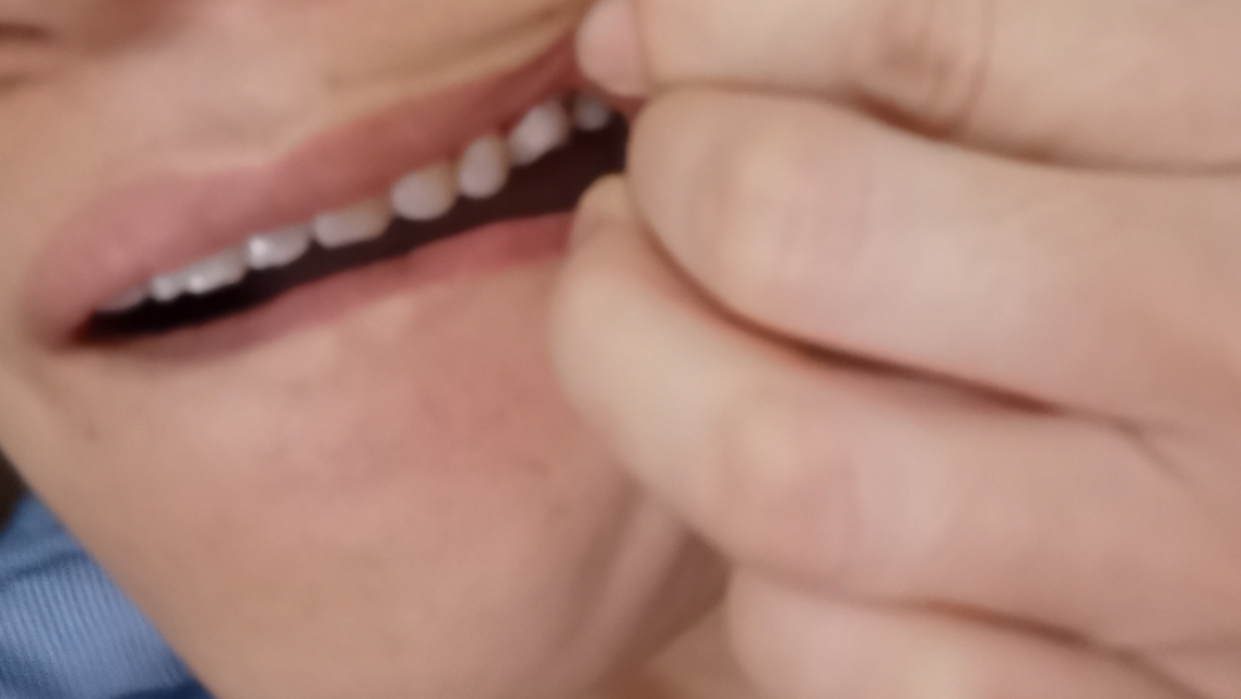 牙齿根管治疗全过程动画,牙齿第一次做完根管治疗