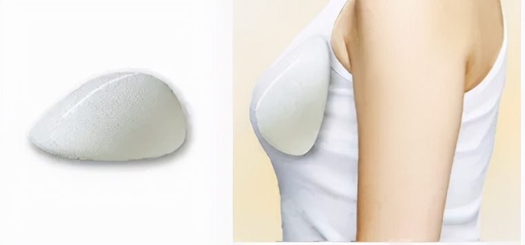 假体隆胸5大流言正解,假体隆胸科普