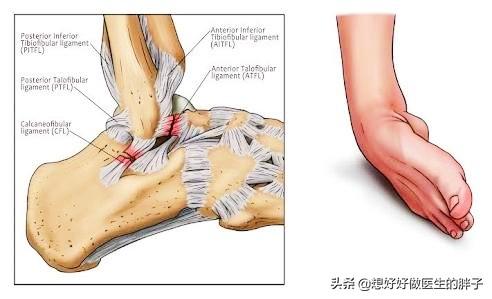 关于踝关节扭伤的正确处理方法,崴脚得重视