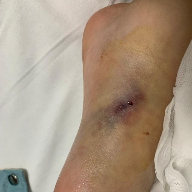 眼镜蛇咬伤急救现场视频,被眼镜蛇咬了怎么办急救