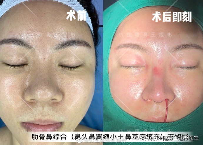 大鼻头缩小的改善原理,鼻头毛孔粗大如何改善缩小毛孔