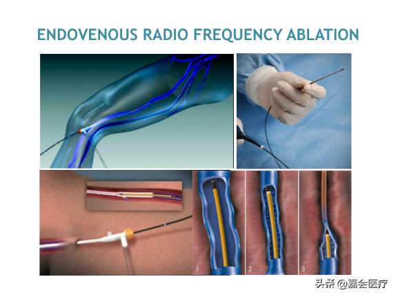 青花釉蚯蚓纹,宣德青花蚯蚓纹