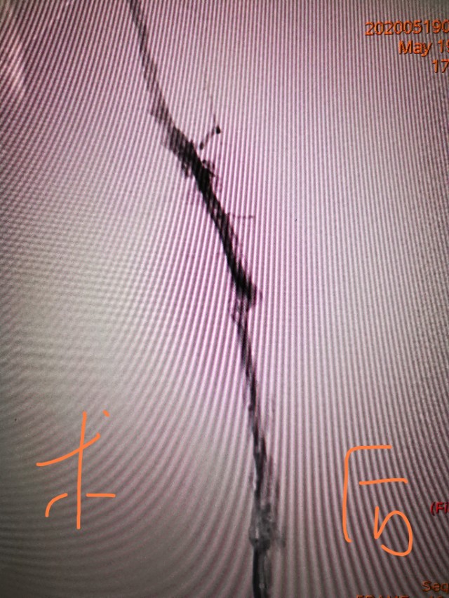 小腿发痒要警惕静脉曲张,小腿深静脉血栓的治疗方法是什么