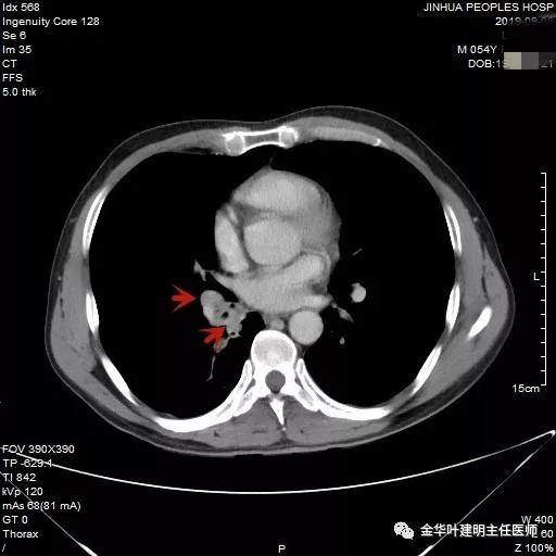 省级医院也漏诊?还好没耽误病情!我们予以行右中下叶袖式切除术