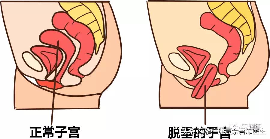 4个好习惯远离盆底问题,怎么预防盆底下垂