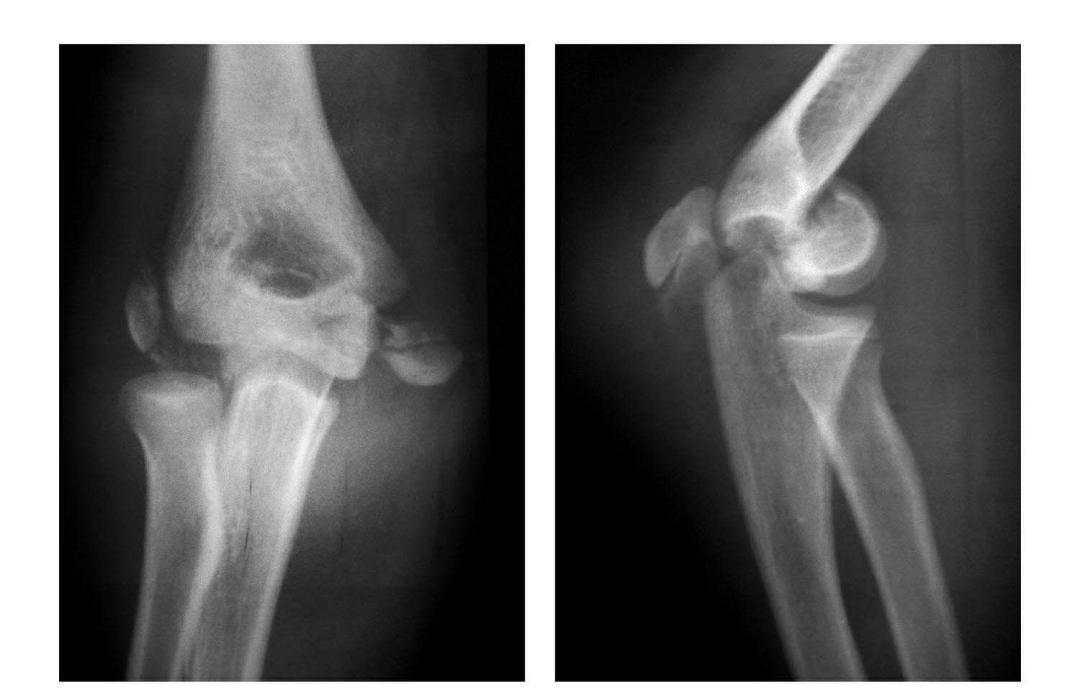 青少年肘部损伤最常见的是,肘部桡神经损伤的临床表现