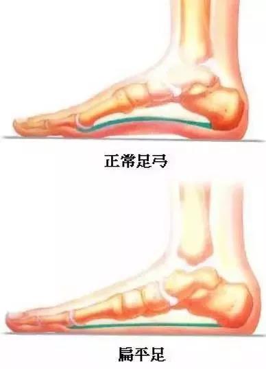 什么是扁平足？日常生活要怎样预防呢？