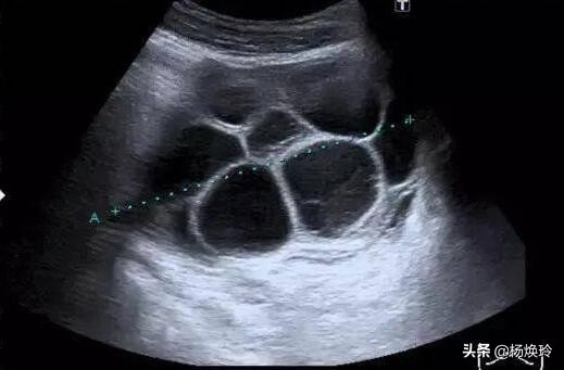 促排卵导致卵巢过度刺激综合征,又凶又险
