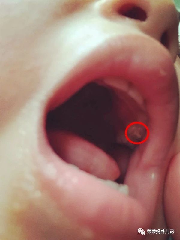 做了窝沟封闭还会蛀牙,蛀齿还需要做窝沟封闭吗