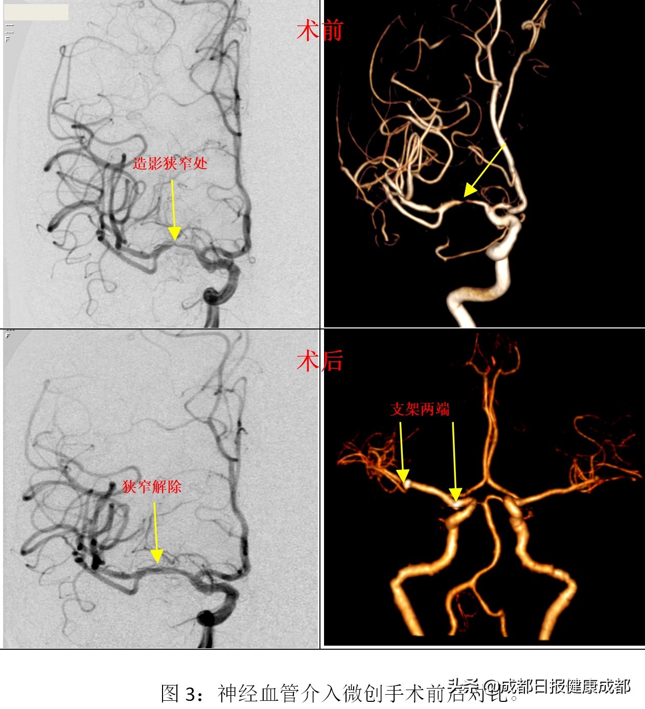 如何控制脑血管中风,脑血管堵了三根做搭桥还是支架