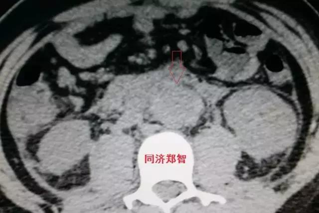 磁共振可以替代cta检查主动脉夹层,主动脉夹层cta上如何分辨真假腔