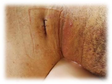 脊柱外科微创融合,脊柱外科微创手术成功案例