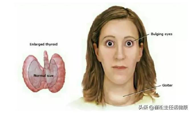 怕热心慌是什么情况,怕热出汗心慌怎么回事