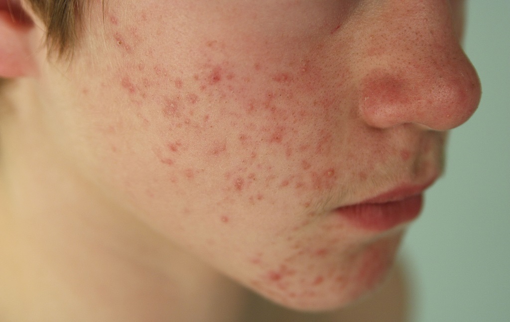 补水喷雾是越喷越干吗,补水喷雾用不好对皮肤